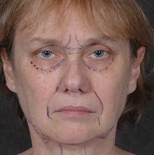Ponytail Facelift before and after, case 62 (before)