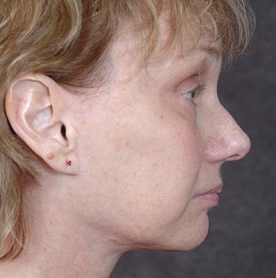 Ponytail Facelift before and after, case 62, view 3 (after)