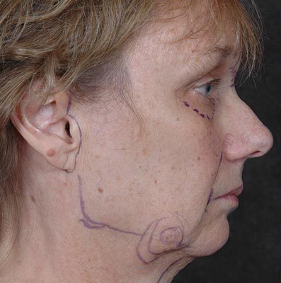 Ponytail Facelift before and after, case 62, view 3 (before)