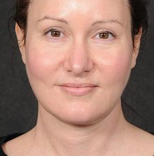 Ponytail Facelift before and after, case 63 (after)
