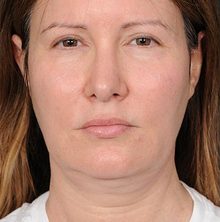 Ponytail Facelift before and after, case 63 (before)