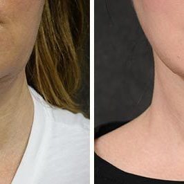 Ponytail Facelift before and after, case 63, view 2 (progress)