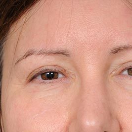 Ponytail Facelift before and after, case 63, view 3 (before)
