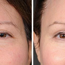 Ponytail Facelift before and after, case 63, view 3 (progress)