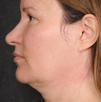 Ponytail Facelift before and after, case 63, view 4 (before)