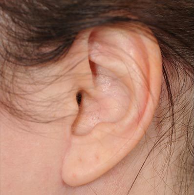 Ponytail Facelift before and after, case 63, view 5 (before)