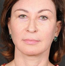Ponytail Facelift before and after, case 64 (after)