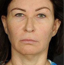 Ponytail Facelift before and after, case 64 (before)