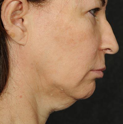 Ponytail Facelift before and after, case 64, view 3 (before)