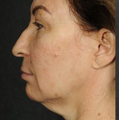 Ponytail Facelift before and after, case 64, view 4 (before)