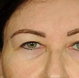 Ponytail Facelift before and after, case 64, view 5 (before)