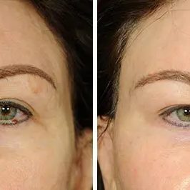 Ponytail Facelift before and after, case 64, view 5 (progress)