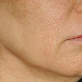 Ponytail Facelift before and after, case 64, view 6 (before)