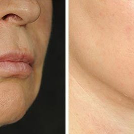 Ponytail Facelift before and after, case 64, view 6 (progress)