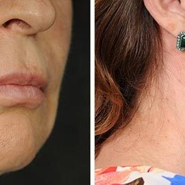 Ponytail Facelift before and after, case 64, view 7 (progress)