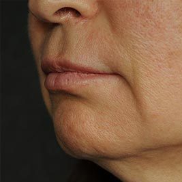 Ponytail Facelift before and after, case 64, view 8 (before)