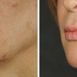 Ponytail Facelift before and after, case 64, view 8 (progress)