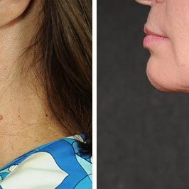Ponytail Facelift before and after, case 64, view 9 (progress)