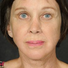 Ponytail Facelift before and after, case 65 (after)