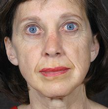 Ponytail Facelift before and after, case 65 (before)