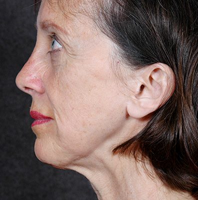 Ponytail Facelift before and after, case 65, view 3 (before)