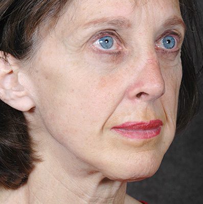 Ponytail Facelift before and after, case 65, view 4 (before)
