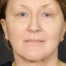 Ponytail Facelift before and after, case 66 (after)