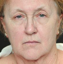 Ponytail Facelift before and after, case 66 (before)