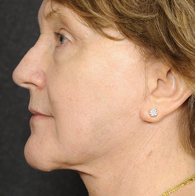 Ponytail Facelift before and after, case 66, view 3 (after)