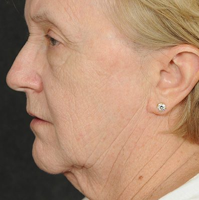 Ponytail Facelift before and after, case 66, view 3 (before)