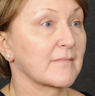 Ponytail Facelift before and after, case 66, view 4 (after)