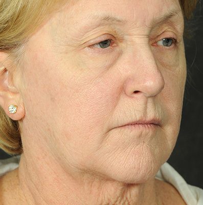 Ponytail Facelift before and after, case 66, view 4 (before)