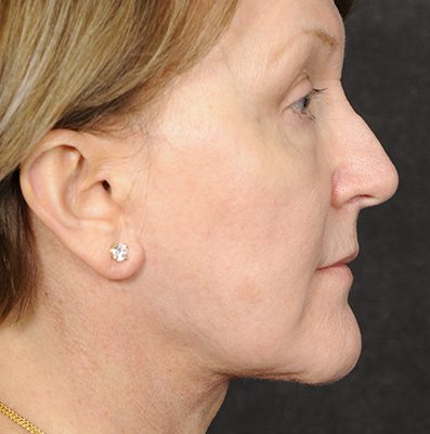 Ponytail Facelift before and after, case 66, view 5 (after)