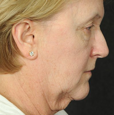 Ponytail Facelift before and after, case 66, view 5 (before)