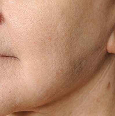 Ponytail Facelift before and after, case 66, view 6 (after)