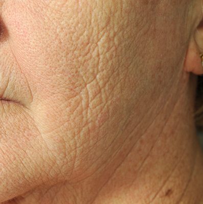 Ponytail Facelift before and after, case 66, view 6 (before)