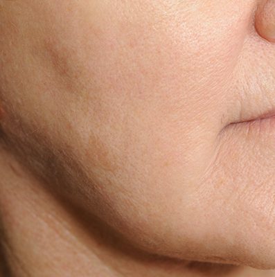 Ponytail Facelift before and after, case 66, view 7 (after)