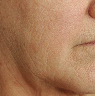 Ponytail Facelift before and after, case 66, view 7 (before)