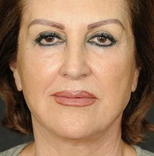 Ponytail Facelift before and after, case 67 (after)