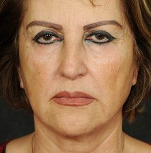 Ponytail Facelift before and after, case 67 (before)