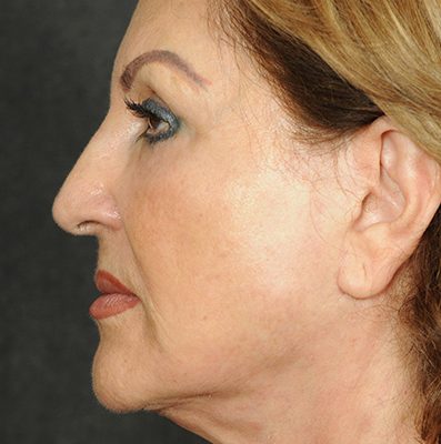 Ponytail Facelift before and after, case 67, view 3 (after)