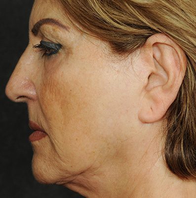 Ponytail Facelift before and after, case 67, view 3 (before)