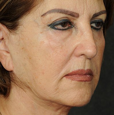Ponytail Facelift before and after, case 67, view 4 (before)