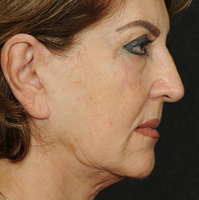 Ponytail Facelift before and after, case 67, view 5 (before)