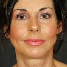 Ponytail Facelift before and after, case 68 (after)