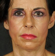 Ponytail Facelift before and after, case 68 (before)