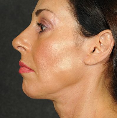 Ponytail Facelift before and after, case 68, view 3 (after)