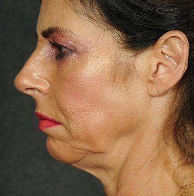 Ponytail Facelift before and after, case 68, view 3 (before)