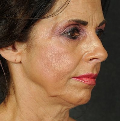 Ponytail Facelift before and after, case 68, view 4 (before)