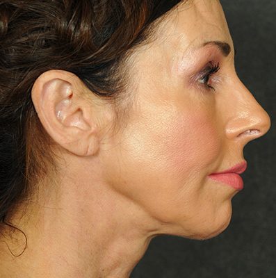 Ponytail Facelift before and after, case 68, view 5 (after)